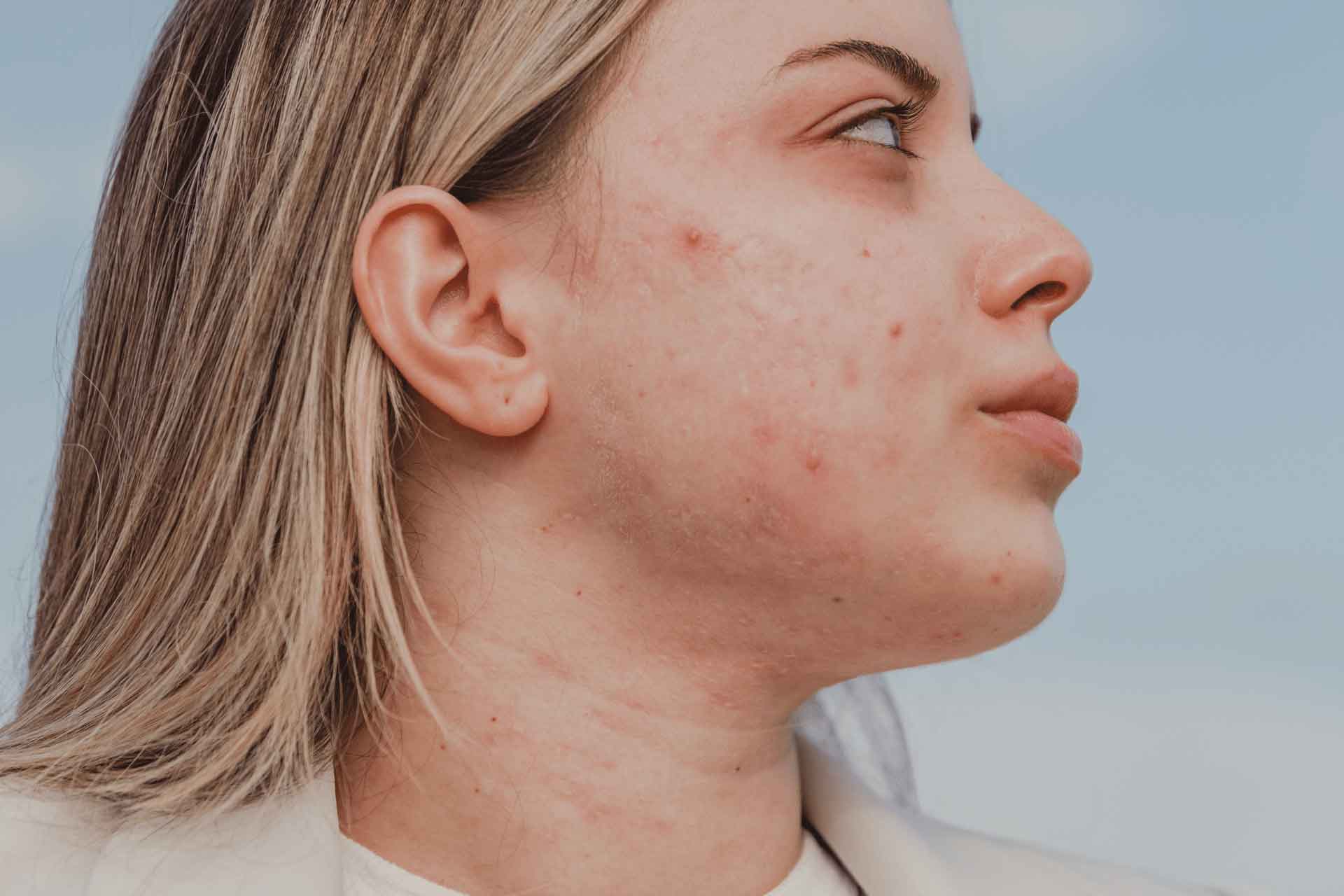 función-barrera-facial-equilibrio-probiótico-figueres-manto-hidrolipidico