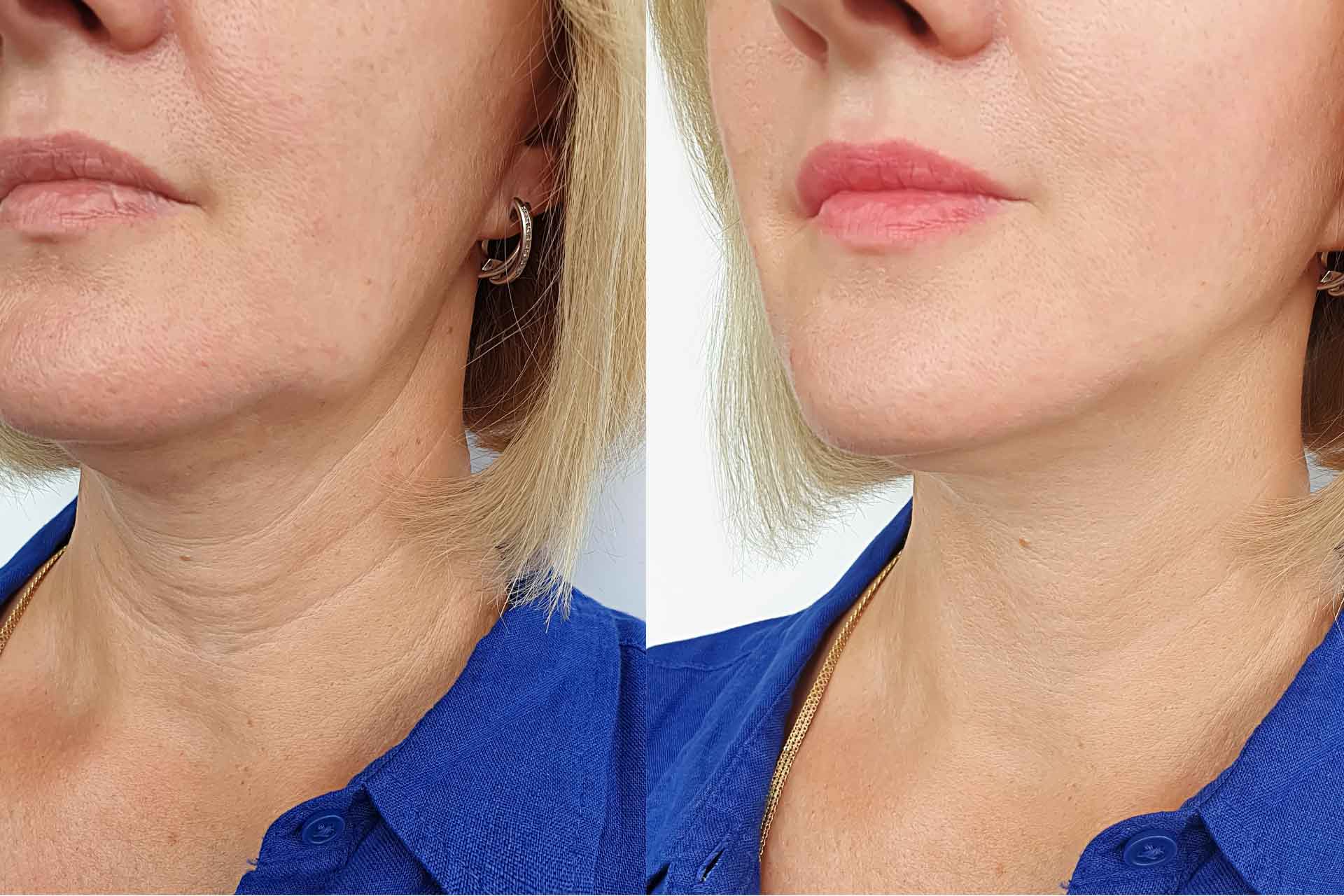 polinucleotidos-tratamiento-facial-figueres-antes-y-despues-rejuvenecimiento-cicatrices